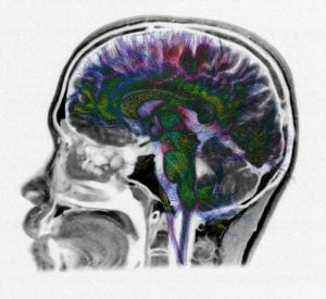 ketamine for ptsd brain scan